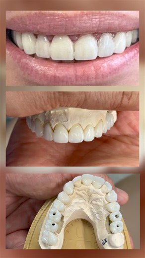 Zirconia crowns that were just completed in my lab today for Dr. Howard Abrahams in Florida