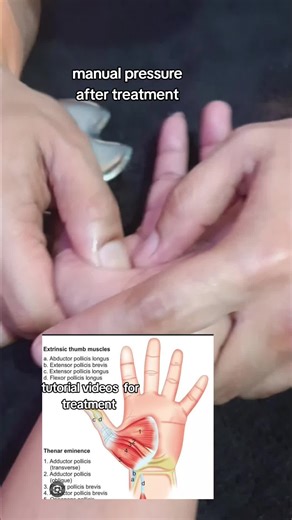 Effective Manual Therapy for Thumb Muscles: A Comprehensive Treatment Guide
