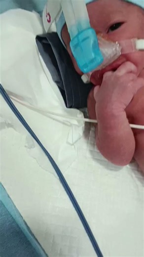 Preterm Baby on CPAP Support|NICU Care for Premature baby #nicubaby #newborn #prematurebaby