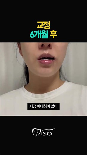 얼굴이 반듯해 지는 가장 손쉬운 방법 #강남역치과#양악교정#안면비대칭교정#주걱턱교정#턱관절교정
