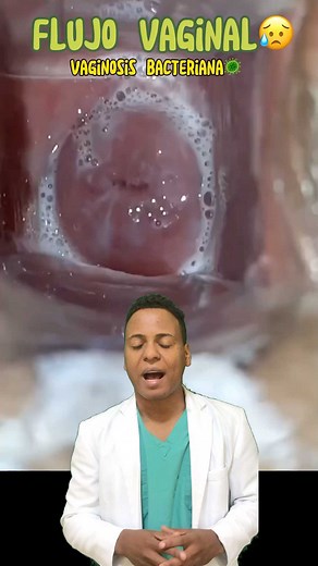 Nelson Suarez Collado on Instagram: "Una vaginosis bacteriana es una vaginitis debida a una alteración compleja de la flora vaginal en la que disminuye la cantidad de lactobacilos y aumenta la de anaerobios patógenos. . Los patógenos anaerobios que crecen son especies de Prevotella y Peptostreptococcus, Gardnerella vaginalis, especies de Mobiluncus y Mycoplasma hominis, que aumentan su concentración por 10 a 100 veces y reemplazan a los lactobacilos protectores. . Los síntomas pueden incluir un 