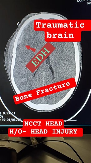 NCCT HEAD|HEAD INJURY|EDH#headinjury #trauma #traumarecovery #braininjury #trendingshorts #reels