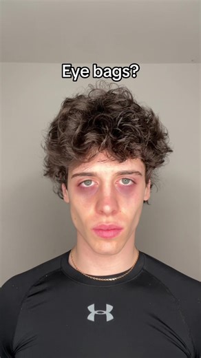 Fix your insecurities #eyebags #mensselfcare how to get rid of your eyebags #looksmax