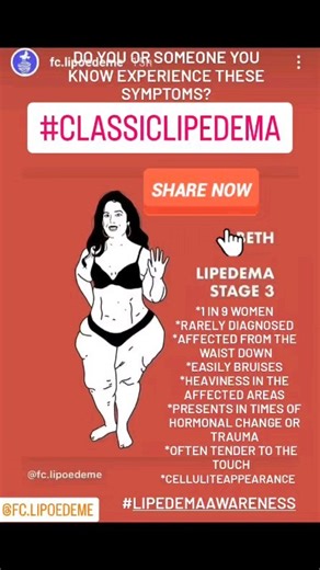 CHECK OUT these symptoms and share with those you think may experience just a few of the ways Lipedema shows in up at least 11% of women worldwide to help us create Awarenes for this disease, Lipedema, that is rarely diagnosed. Please share to your medical providers, as well, so we can alert medical professionals and get thwm interested in learning more about Lipedema and how it affects their patients. Are you already diagnosed with Lipedema or suspect you are part of the 1 in 9 women that does 