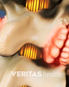 This is how a bone spur causes pain. | Spine-health