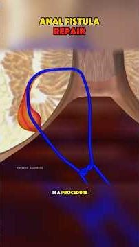 How Anal Fistula Is Repaired? (3D Animation) #fistulas #healing #infection #glands #comfort #surgeon