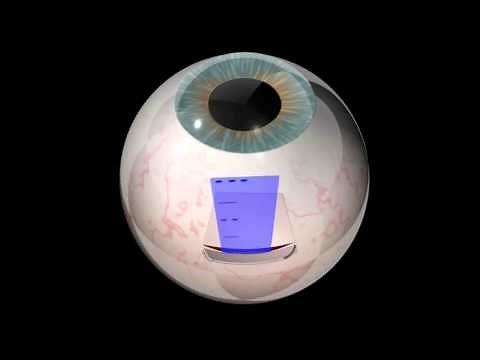 Retinal implant trial at John Radcliffe Hospital, Oxford