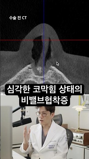 심각한 코막힘 상태의 비밸브협착증 #기능코성형 #비염 #코막힘