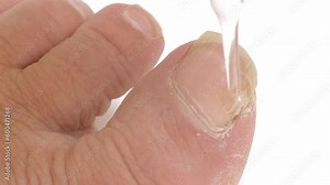 dermatologist, dermatovenereologist, podologist treats damaged rude nail on big toe of female foot, exfoliation, nail fungus, treatment Nail onycholysis, Paramedical, Medical pedicure, aging problems