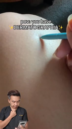 Dr Lim Ing Kien | Dermatology on Instagram: "Dermatographia (skin writing disorder) A physical form of urticaria triggered by pressure or friction on the skin. The reaction is caused by histamine release and is temporary. Skin markings resolve spontaneously within a short time. Treatment is generally unnecessary unless symptoms are persistent."