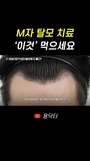 M자 탈모 치료에 '이것' 먹어야 하는 이유! 대부분이 잘못 알고 있습니다.. (프로페시아 vs 아보다트)