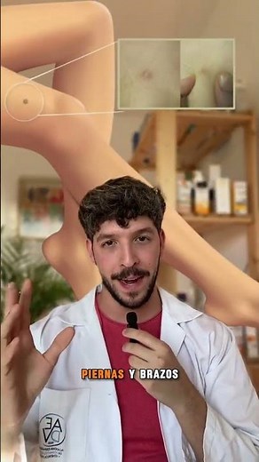 El dermatofibroma es un nódulo cutáneo benigno, firme y de crecimiento lento. Suele aparecer