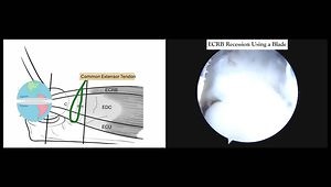 Arthroscopic Recession Technique in Tennis Elbow Surgery