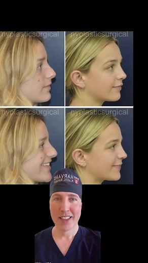 The Importance of Tip Support in Rhinoplasty