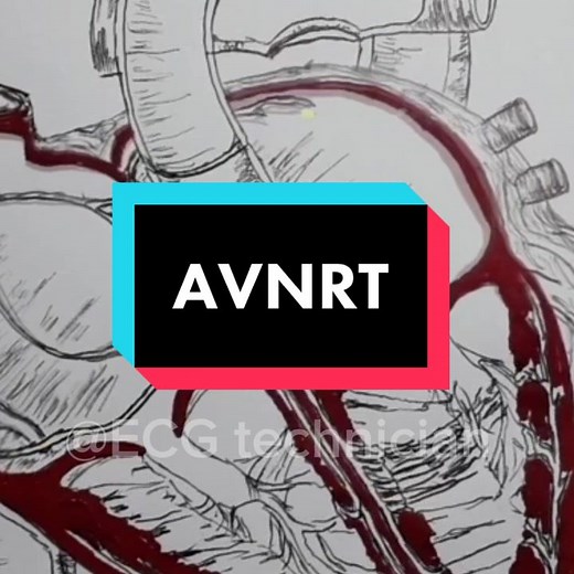 تسارع النبض الفوق بطيني (AVNRT) وأعراضه الأساسية