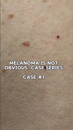 Melanoma is not obvious