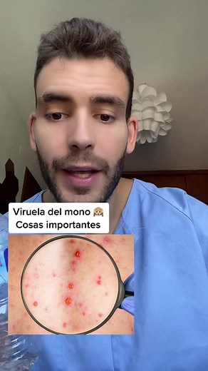 Viruela del Mono: Transmisión y Síntomas