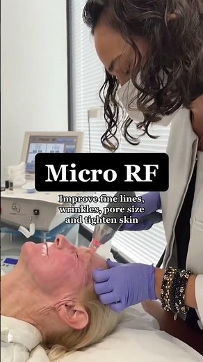 Microneedling with Radio Frequency to Treat Fine Lines and Wrinkles