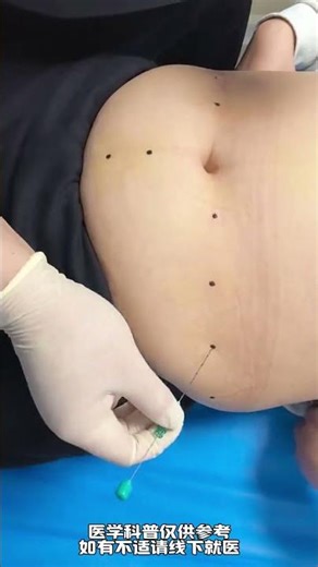 Obesity weight management thread embedding treatment#Obesity#Thread burial for weight loss