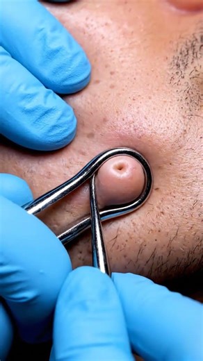 Every Jawline Pore Cleared One by One | Ultra-Realistic Extraction #viral #shortvideo #shorts #fyp