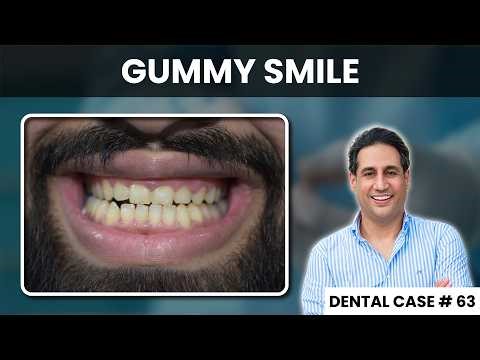 Gummy Smile Correction Before and After | Best Dentist in Lahore | Dental Case # 63