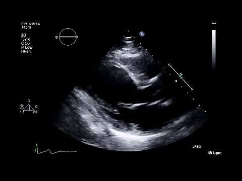 Ejection Fraction Practice On Echocardiogram