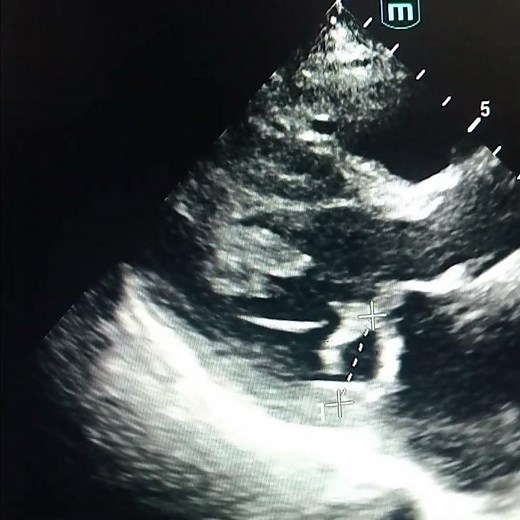 posterior mitral valve leaflet prolapse,