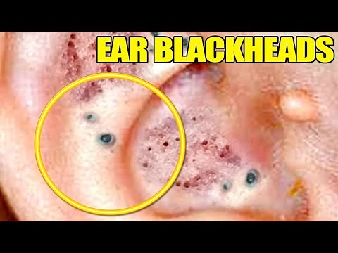 Ear Blackheads Extreme, 2020's Goldmine of Blackheads