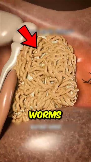 If You Ever Find Worms in Your Ear, Do This Immediately!