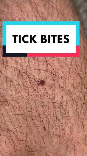 Tick removal?!? #learnontiktok #tiktokpartner #tick #tickremoval