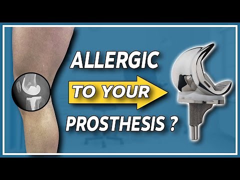 How to detect and overcome metal allergy in knee and hip replacements?