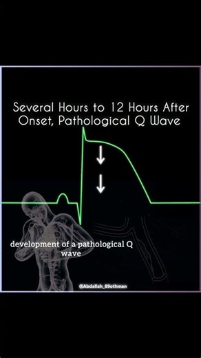 ECG Changes in Myocardial Infarction 🫀 | Heart Attack ECG Explained