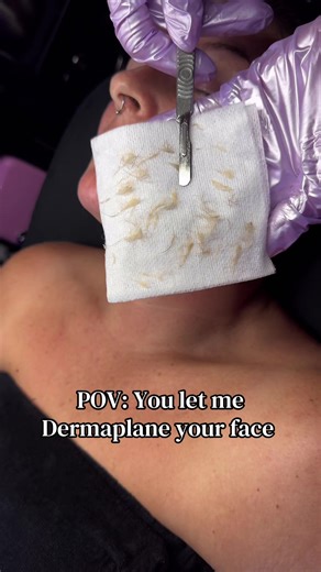 Experience Dermaplaning: A Skincare Transformation