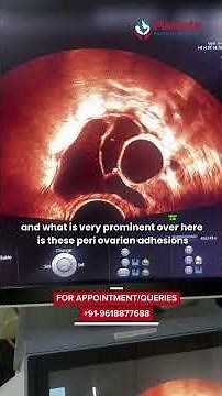 How do Peritoneal Inclusion Cysts look on Ultrasound? | Mamata Fertility Hospital: Hyderabad