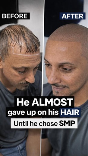 SMP Masters | Long Island on Instagram: "Michael didn’t lose his hair overnight. And he didn’t lose his confidence in one day either. For years, he tried to ignore his thinning hairline. He avoided photos. He avoided mirrors. He thought surgery was his only option. But Michael didn’t want a transplant. He wanted something natural. Something realistic. That’s when he discovered Scalp Micropigmentation (SMP). No surgery. No medication. No wigs. Just a restored hairline and renewed confidence. 📍 L