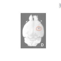 Video: Establishing Intracranial Brain Tumor Xenografts With Subsequent Analysis of Tumor Growth and Response to Therapy using Bioluminescence Imaging