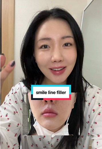 Transform Your Smile Lines: My Filler Experience
