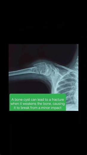 A bone cyst can lead to a fracture when it weakens the bone, causing it to break from a minor impact