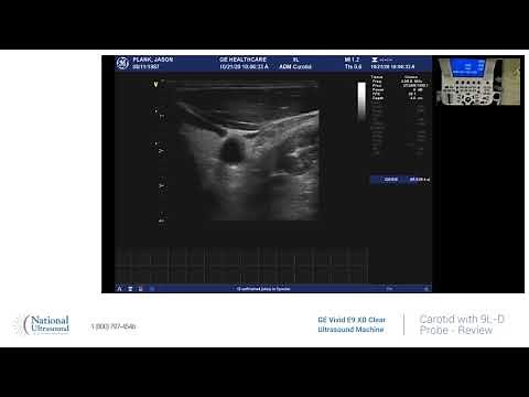 GE Vivid E9 XD Clear Carotid Ultrasound Training Video with 9L D probe