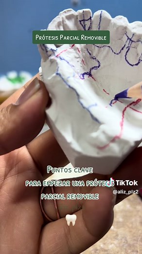 Diseño completo de prótesis dental: Paso a paso y puntos clave