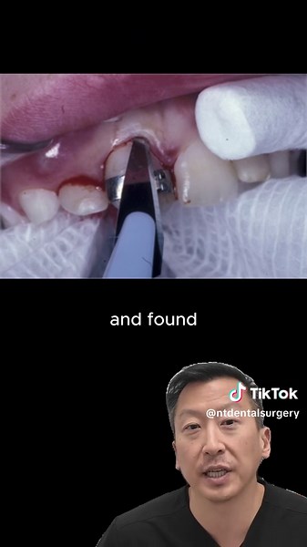 Finished braces or Invisalign and your teeth started shifting back? That’s orthodontic relapse. In some cases, a small procedure called a fiberotomy can help reduce the chance of certain teeth rotating back after treatment. Retainers are still a must, but this can be a helpful extra step in the right case. Follow us for more dental content and before & after posts #braces #invisalign #orthodontics #ortho #periodontist