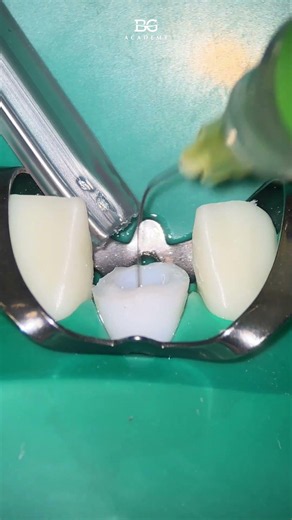 Instrumentation. #endo #endodontic #dentistry