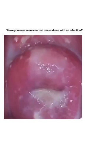 explaining. biology on Instagram: "Cervix: Normal vs. Infected 🟢 Normal Cervix Pink, smooth, and moist appearance. Clear or slightly milky mucus (discharge). No strong odor. No sticky or clumpy discharge attached to the surface. 🔴 Cervix with Infection Red, swollen, or irritated appearance. Thick, yellow, green, or white discharge. Sticky secretion that clings to the cervix. May be associated with odor, itching, pain, or bleeding. ⚠️ Important Note: When discharge sticks to the cervix, it ofte