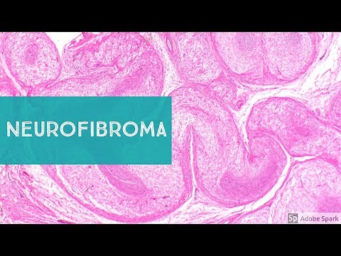 Neurofibroma, Neurofibromatosis-1, and Low Grade MPNST