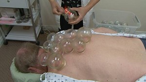 Doctor Demonstrates Cupping Celeb Trend
