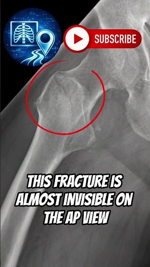 This Hip X-Ray Looks Normal… Until You Change the View #radiology