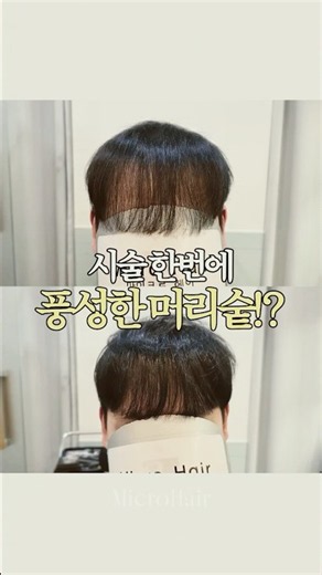 시술 한번에 풍성한 머리숱!? #머리숱 #앞머리붙임머리 #증모 #탈모 #탈모관리 #머리기르기
