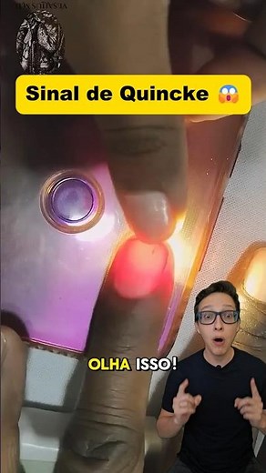 Sinal de Quincke 😱#medicina #medico #enfermagem #enfermeiro #enfermeira insuficiência Aórtica