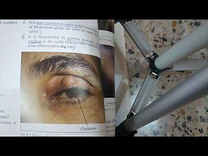 EYELIDS lecture 2 CHALAZION and HORDOLEUM in easiest way with all important things