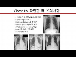 흉부 X선 (Chest X-ray) 사진 판독, version 2